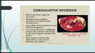 Necrosis  Pathology Learning [upl. by Lerrehs33]