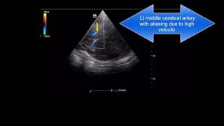 transcranial doppler in meningitis [upl. by Patience]