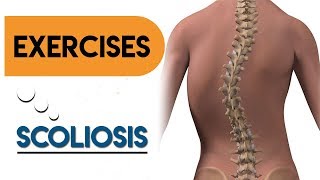 Effective Scoliosis Exercises at Home [upl. by Aviva98]