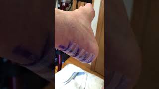 Post Surgery DAY 20 left calcaneus heel spur Achilles repair [upl. by Itnahsa]