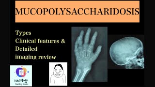 MUCOPOLYSACCHARIDOSIS Case discussion of types clinicoradiological features Morquios amp Hurlers [upl. by Masera77]