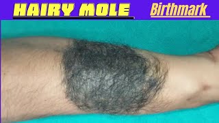 Birthmark Removal Surgery of hairy mole  Nevus removal surgery in Ranchi birthmark [upl. by Ynavoj]