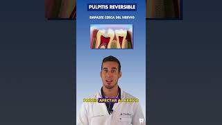 Estas son las CAUSAS de la PULPITIS reversible o INFLAMACIÓN del NERVIO DENTAL [upl. by Hadria]