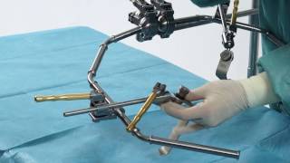 Retractor for ventral access  Spine Surgery [upl. by Ahker772]