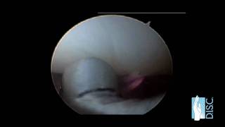 Wrist Arthroscopy Surgery [upl. by Sundin44]