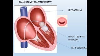 Mitral valve balloon valvuloplasty in MS patients [upl. by Batruk523]