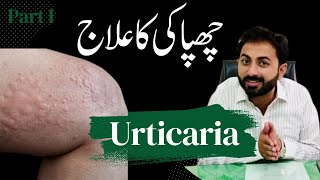 Types of Urticaria amp Homeopathy Treatment [upl. by Eiznikam]