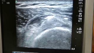 Hyalgan injection under ultrasound guidance at subdeltoid bursa for tendinosis [upl. by Axe597]