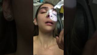 Removing a Nasal Stent 5 Days after Rhinoplasty [upl. by Grote237]