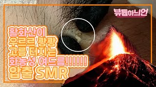 압출smr 21 대왕 여드름 압출 20대 男 씨앗이 크고 깊은 여드름 [upl. by Erehpotsirhc]