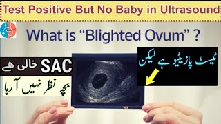 Pregnancy Test Positive But No Baby in Ultrasound  No HeartBeat at 6Weeks  Empty Sac UrduHindi 🌐 [upl. by Rodd494]