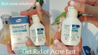 How to get rid of acne fast  Dalacin T lotion Review Clindamycin [upl. by Kruse]