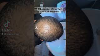 regrowing hair without finasteride [upl. by Aguste820]