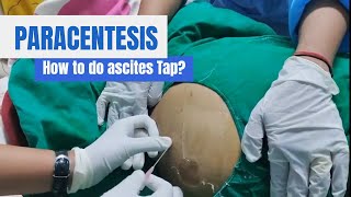 Paracentesis Procedure Ascites Tap in detail [upl. by Isak]