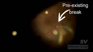 Vitrectomy for SLE Retinopathy [upl. by Anahsat]