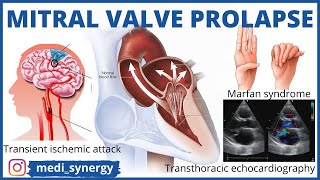 Mitral Valve Prolapse  Basics  Clinical Features  Investigation Complications Treatment HINDI [upl. by Kenison992]