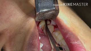 Odontectomy Wisdom Tooth Removal tooth number 38 by thechubbydentist [upl. by Anoy]