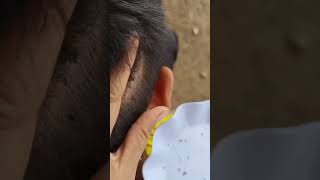 Itchy Scalp Satisfying And Picking Lice [upl. by Diehl]