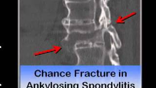 LearningRadiology 37 Sacroiliitis [upl. by Adelia]