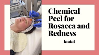 Chemical peel for rosacea and redness on sensitive skin [upl. by Lach18]