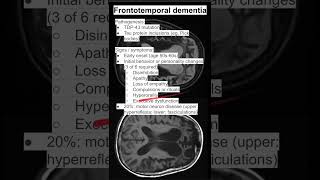 Frontotemporal dementia [upl. by Ennazus]