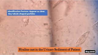 Hyaline cast Introduction normal range clinical significance and Identifications clues [upl. by Airtemak128]