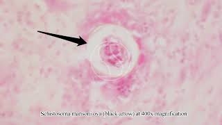 Schistosoma mansoni Ova Egg in Tissue with Haematoxylin and Eosin HampE Stain [upl. by Treb391]