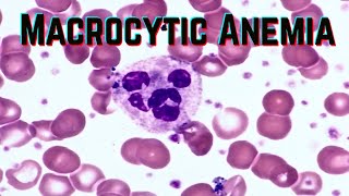 Macrocytic Anemia updated 2021  CRASH Medical Review Series [upl. by Anazus]