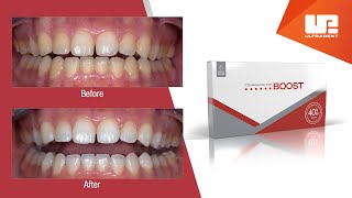 What to Expect with Opalescence Boost Professional Teeth Whitening [upl. by Terrance]