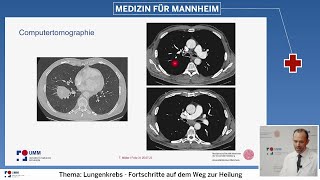 Vom Röntgenbild bis zur Therapie  moderne Diagnostik bei Lungenkrebs [upl. by Gleda]