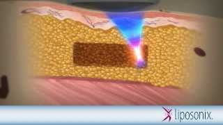 Liposonix Mechanism of Action Animation [upl. by Ennaid]