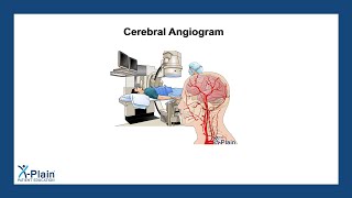 Cerebral Angiogram [upl. by Kristof]