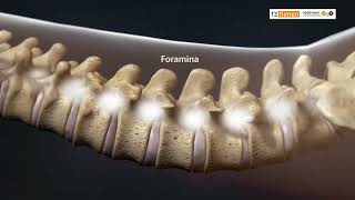Transforaminele Infiltratie [upl. by Juetta]