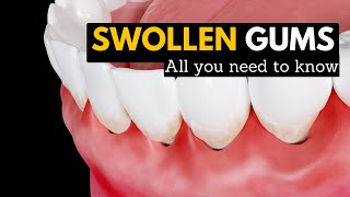 Swollen Gums Explained What You Need to Know and How to Treat Them [upl. by Yrakcaz]