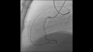 LAD CTO Case 5  wire deescalation [upl. by Clarke]