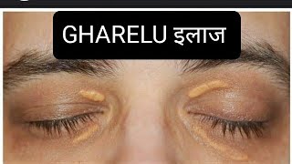 आंखों के पास पीले चकते का घरेलू इलाज  how to self treat XANTHELASMA [upl. by Nester166]