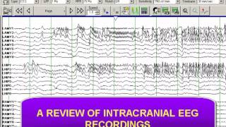 INTRACRANIAL DEPTH ELECTRODE RECORDING [upl. by Magena]