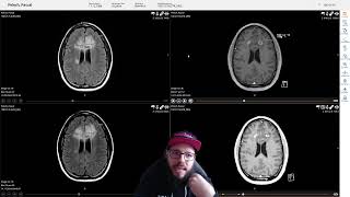 Hirntumor WHO Grade 4 Eine Zweite Biopsie steht bevor [upl. by Akihsat]