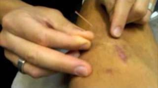 Scar tissue mobilization using myofascial needling [upl. by Remo68]