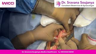 Performing a Bartholin cyst incision and drainage with marsupialization to provide longterm relief [upl. by Kannan216]