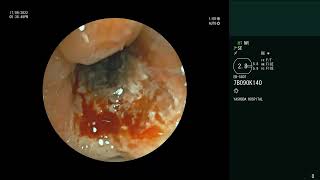 Pulmonary Mucormycosis  Bronchoscopy  Biopsy [upl. by Carita]