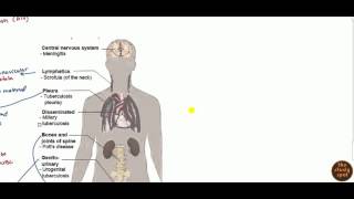 Extrapulmonary TB [upl. by Gottfried]