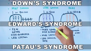 Trisomy  Downs vs Edwards vs Pataus Syndrome [upl. by Teik]