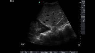 Pleural effusion with lung collapse amp spine sign in right hemithorax [upl. by Stanly883]