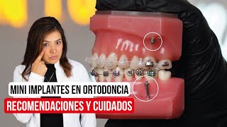 Mini implantes en ortodoncia Recomendaciones y cuidados [upl. by Aisatsana]