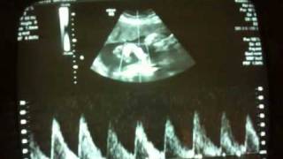 Fetal heart rate  32 week ultrasound [upl. by Duky]