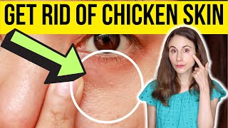 HOW TO GET RID OF CHICKEN SKIN UNDER EYES  Dermatologist [upl. by Mccourt]