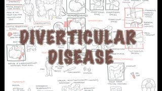 Diverticular Disease diverticulitis  Overview [upl. by Zug436]