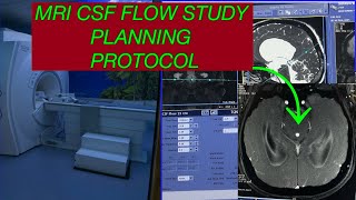 MRI BRAIN WITH CSF FLOW STUDY PLANNING step by step Mri CSF flow study GE Mri CSF flow with Brain [upl. by Beitnes]