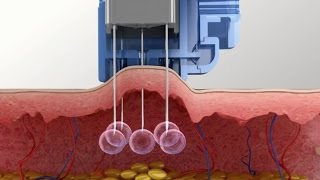 Meso Injector system for Mesotherapy Injection [upl. by Nauj]